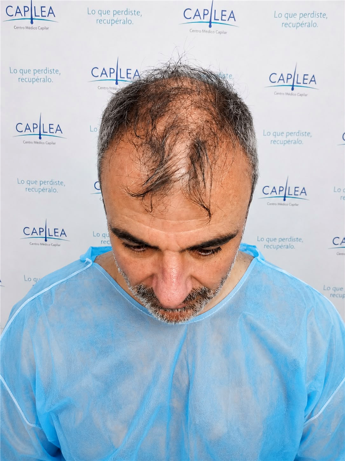 Antes de la restauración capilar
